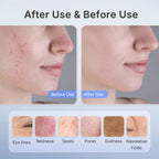 NEVRUXA LED Light Therapy Face Mask